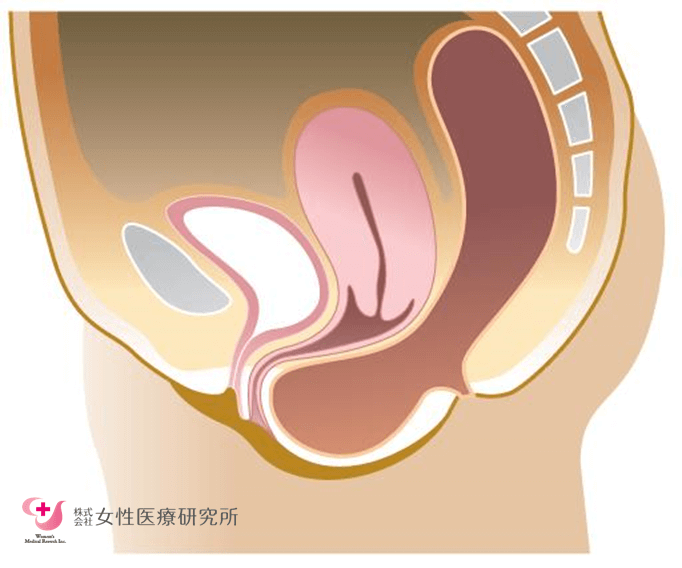 直腸瘤