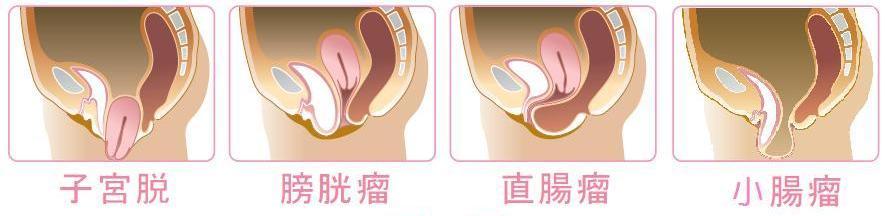 骨盤臓器脱とは